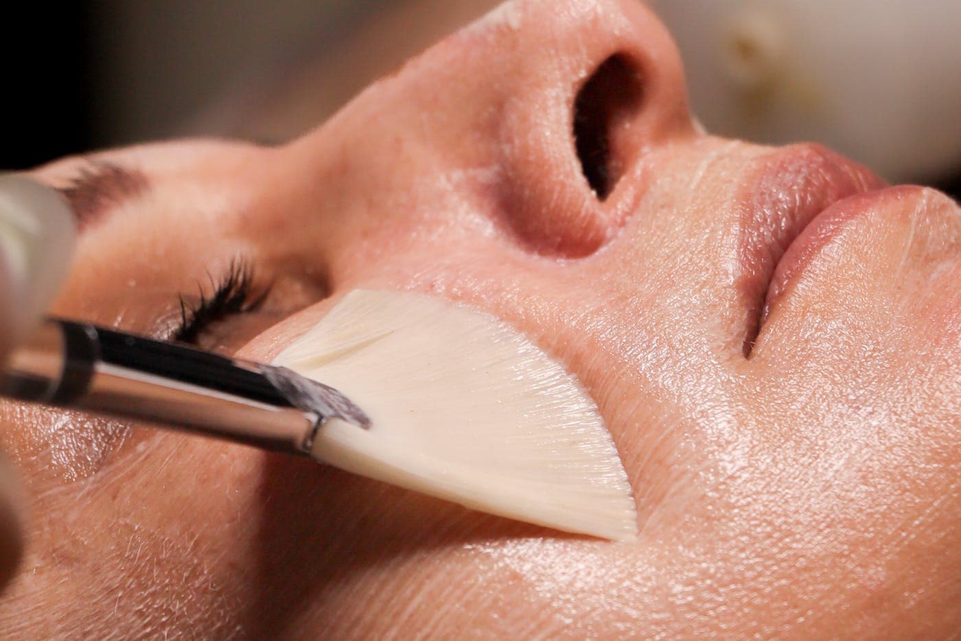 chemical peel Cambridge clinic